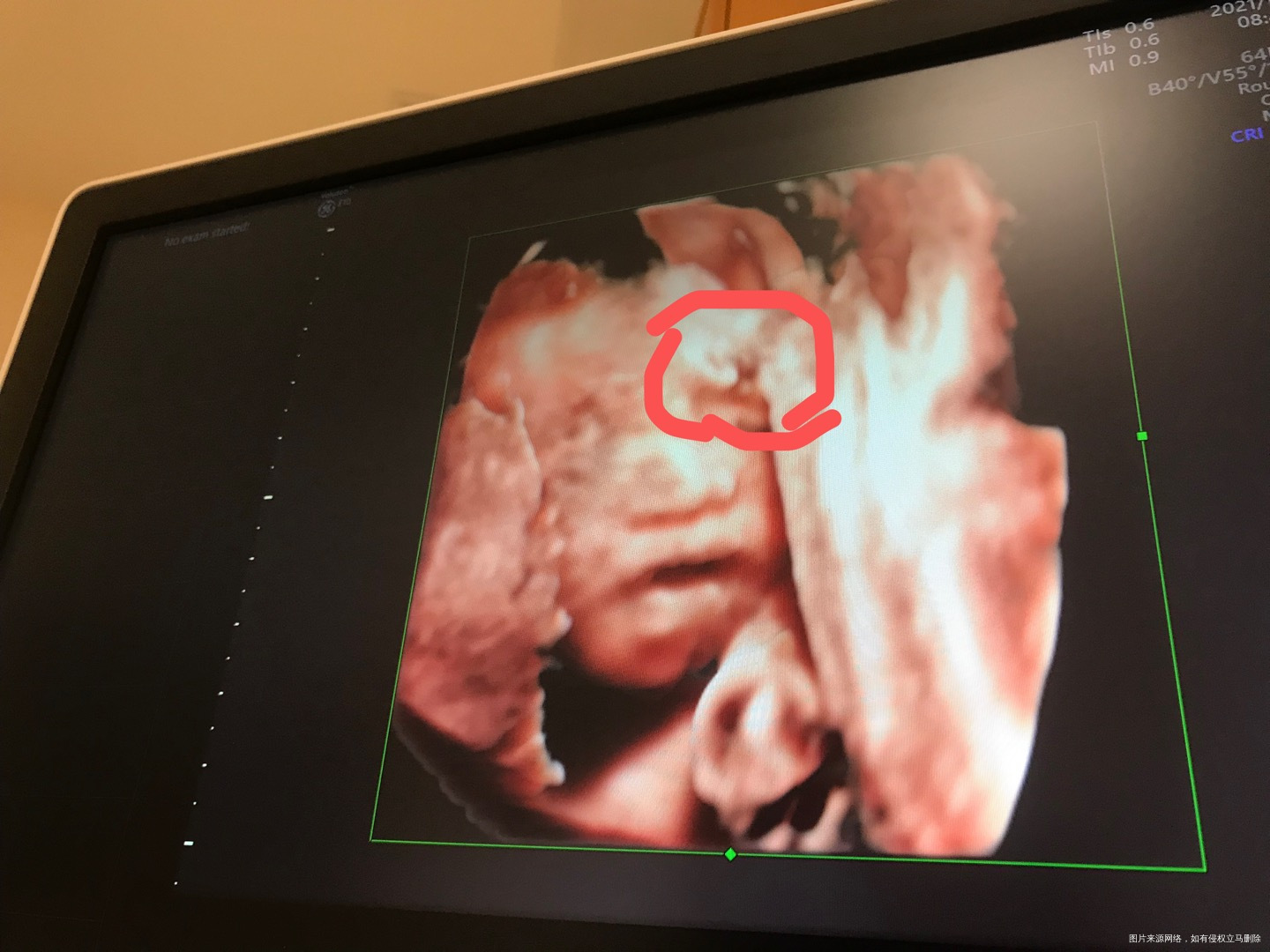 宝宝头上这是啥四维彩超医生说正常的