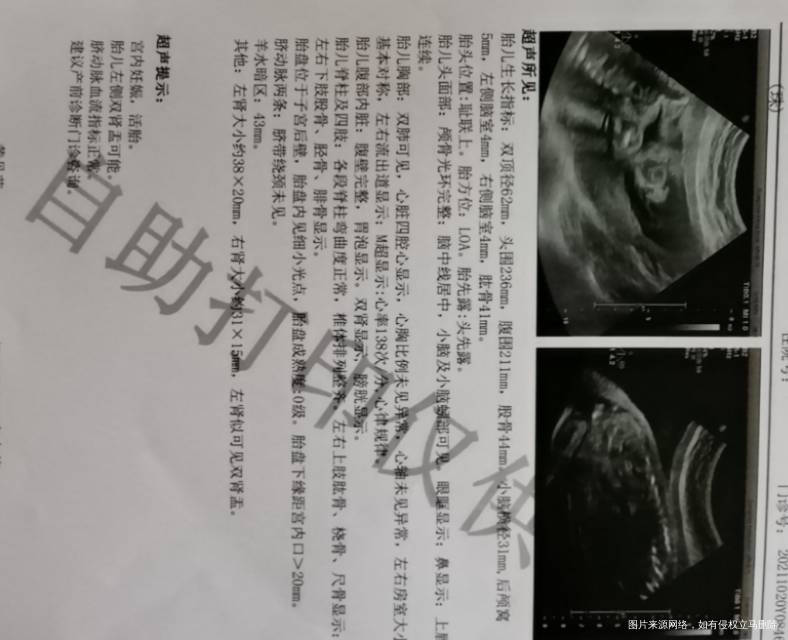 25周四维左肾双肾盂可能去上级医院复查三级产