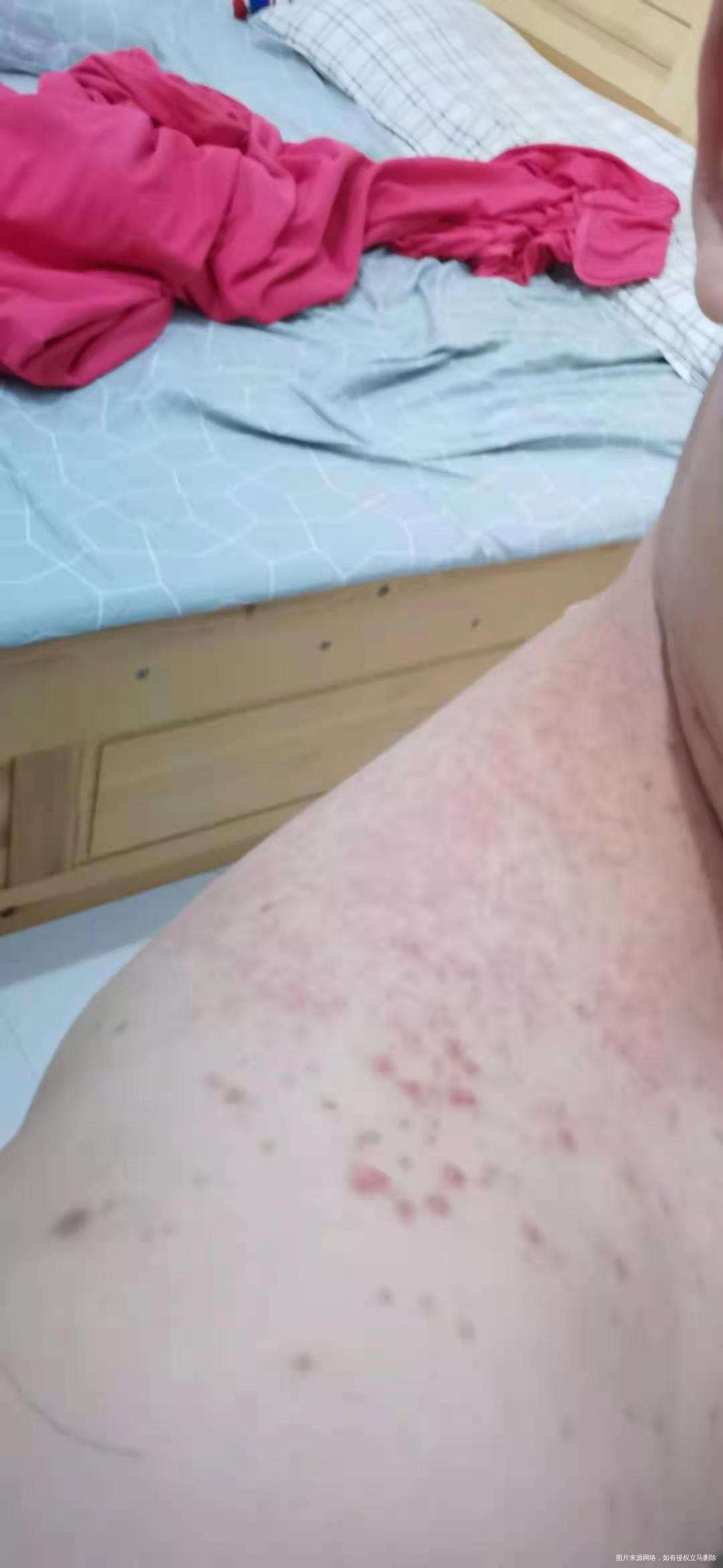 你好请各位生殖科医生帮忙瞧瞧我老公湿疹能吃附