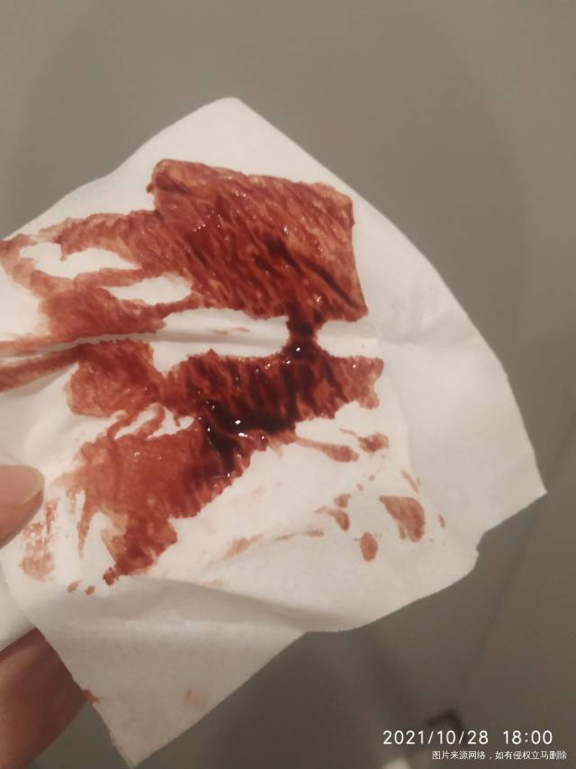 医生好我上周21号做了nt结果正常的也没有提