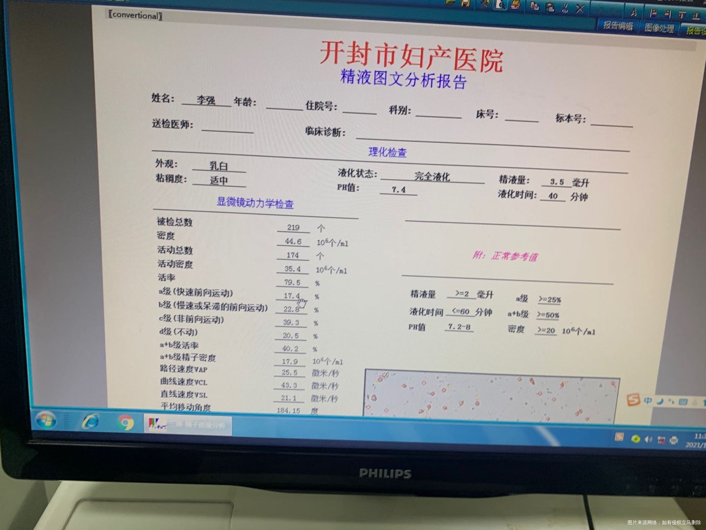 这个精液常规活力正常吗