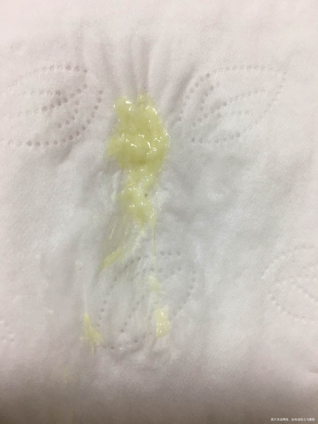 你好医生第二张白带是今天复查的白带很浓绿上次