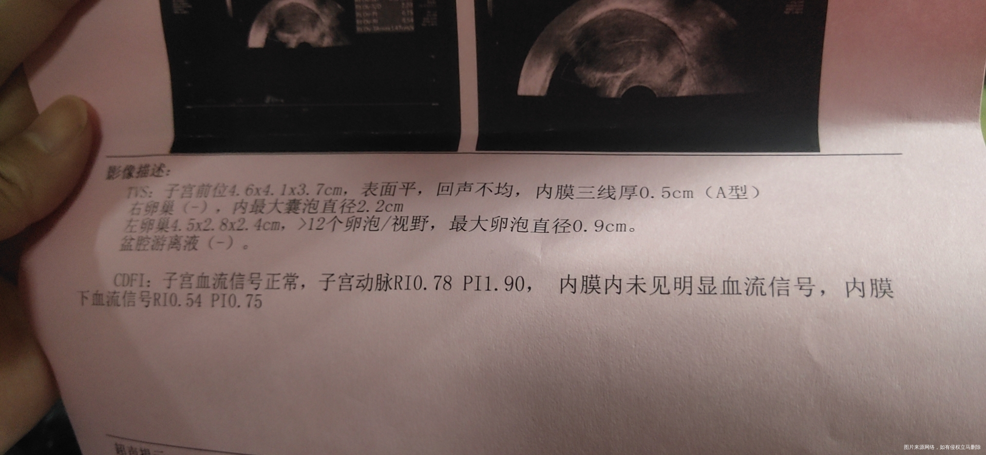 这个样子能做试管移植吗为什么内膜会没有血流信