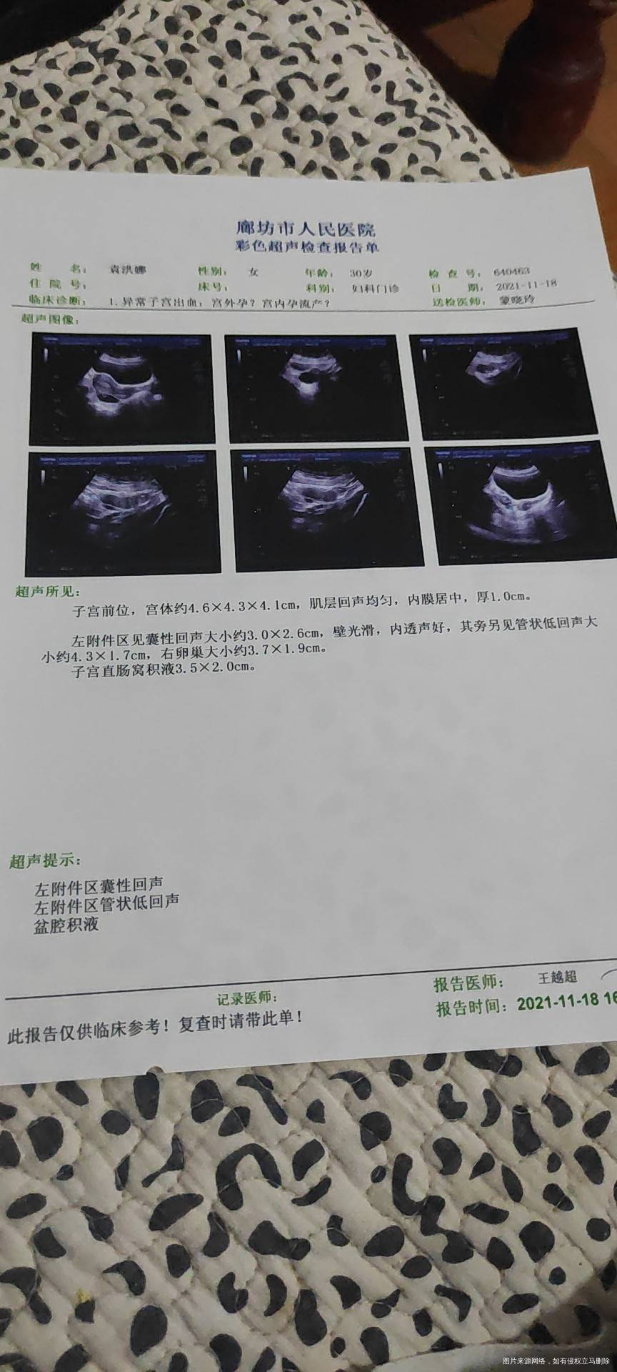 10月13号移植今天抽血202出血18天怀疑