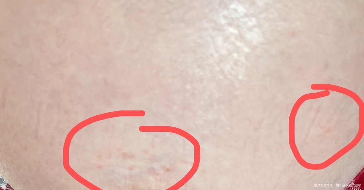 老师们今天孕33w今天发现肚皮有点痒低头一看