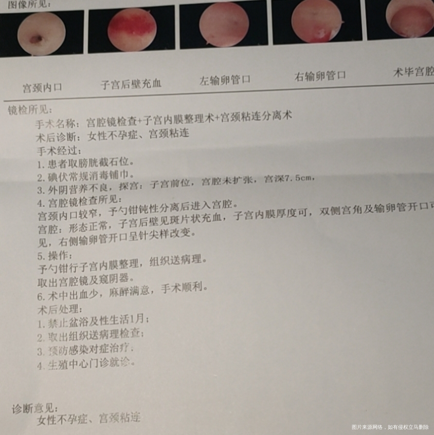 生化2次hcg不是很好输卵管造影后就隐隐的疼