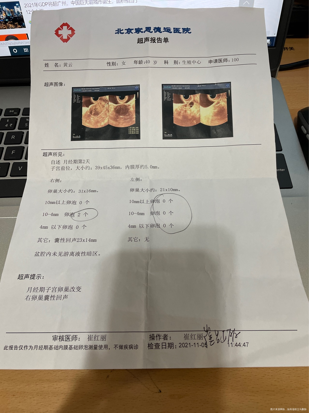 我40周岁二十年未孕2012年曾到北医三院做