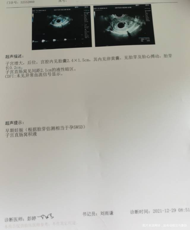 怀孕cdfi未见血流信号正常嘛