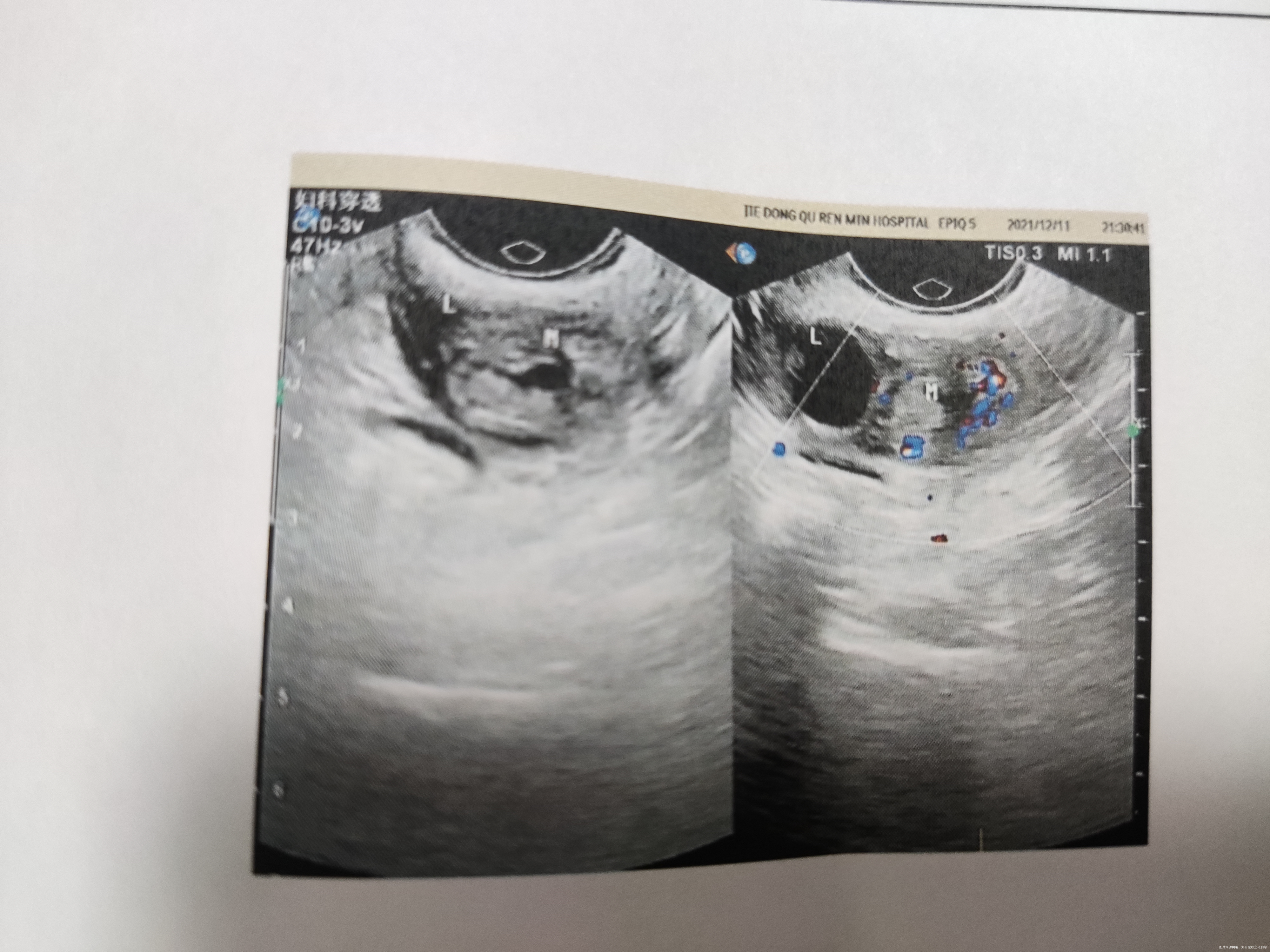 医生好我被诊断为宫外孕目前hcg为500多b