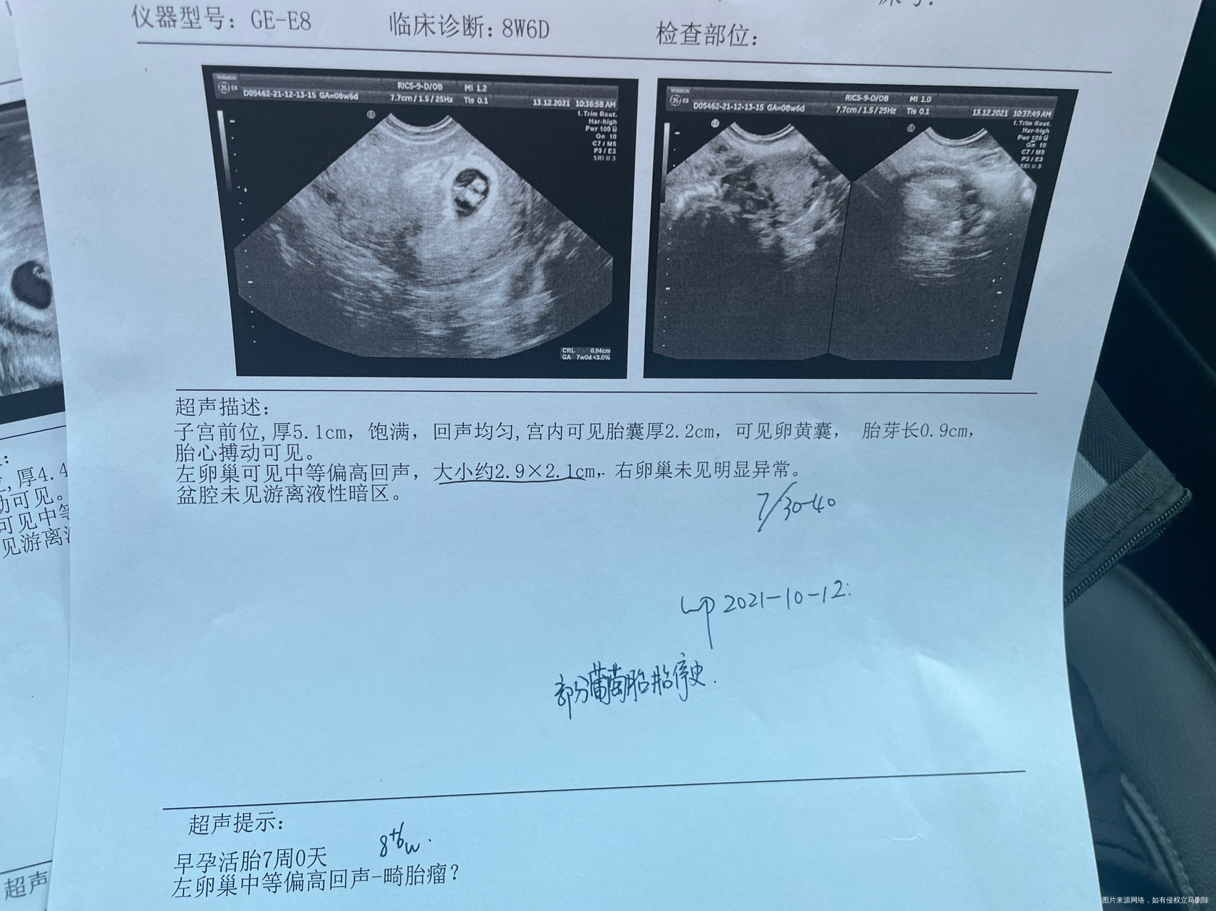 1012号停经1204号孕酮1206ng12