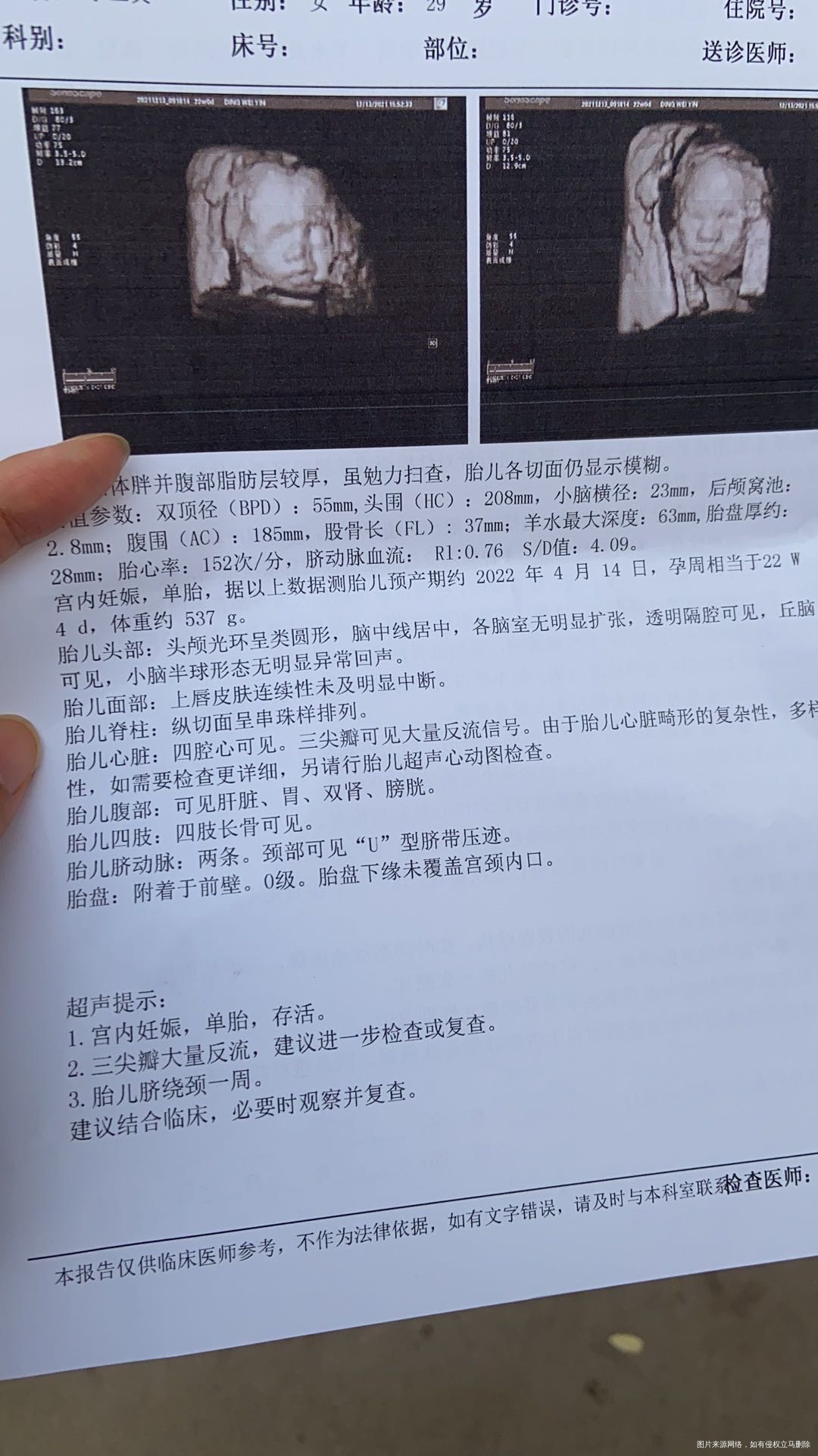 请问有什么问题吗三尖瓣返流问题大吗