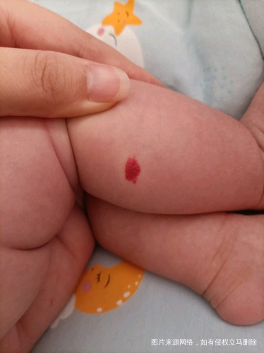非试管婴儿宝宝40天出生没有腿上的红斑但是月