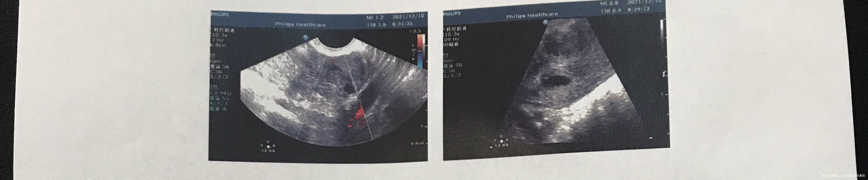 您好大夫11月17日试管移植2个胚胎12月1