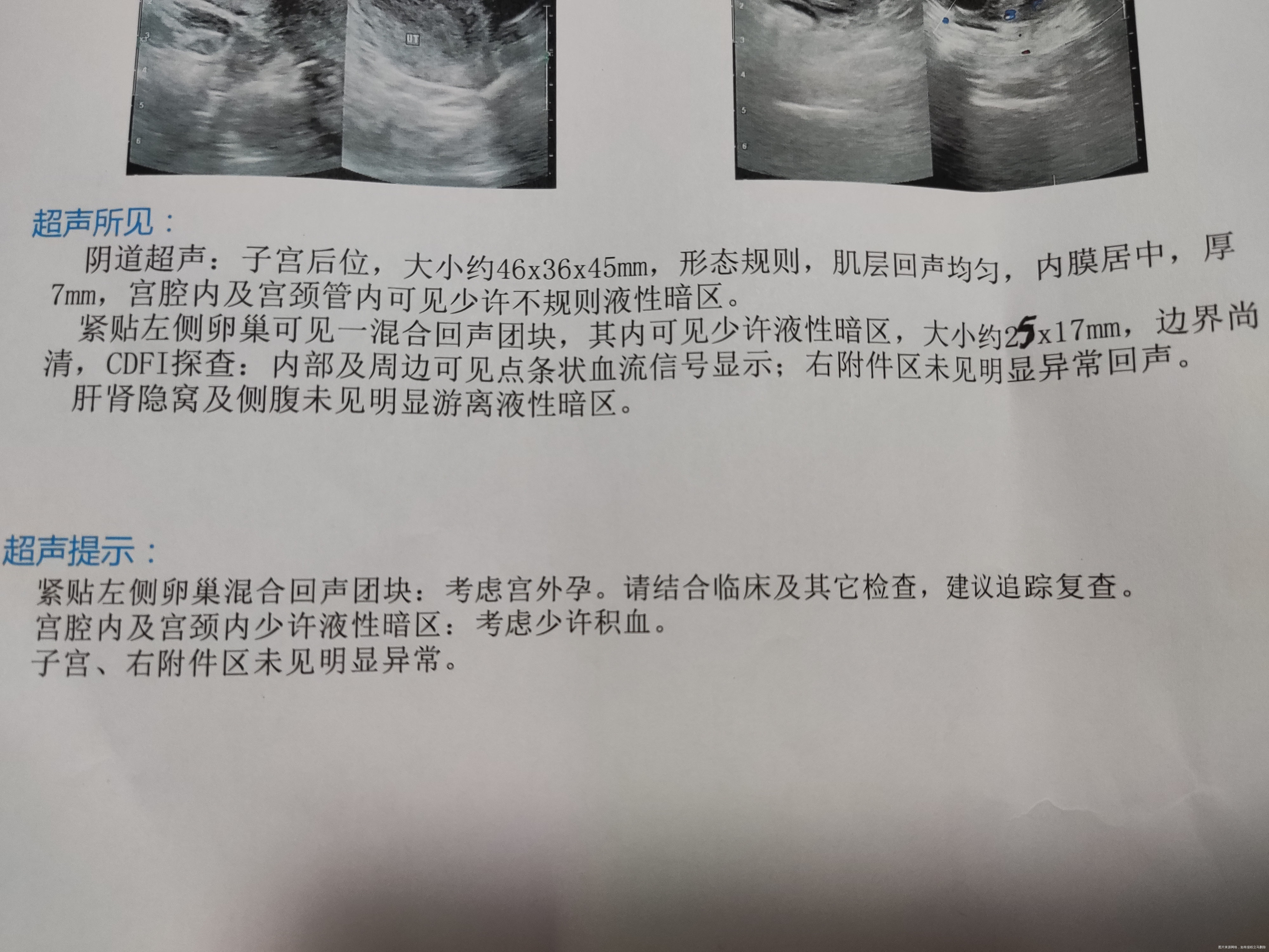 医生好我宫外孕保守治疗吃了米非司酮星期一hc