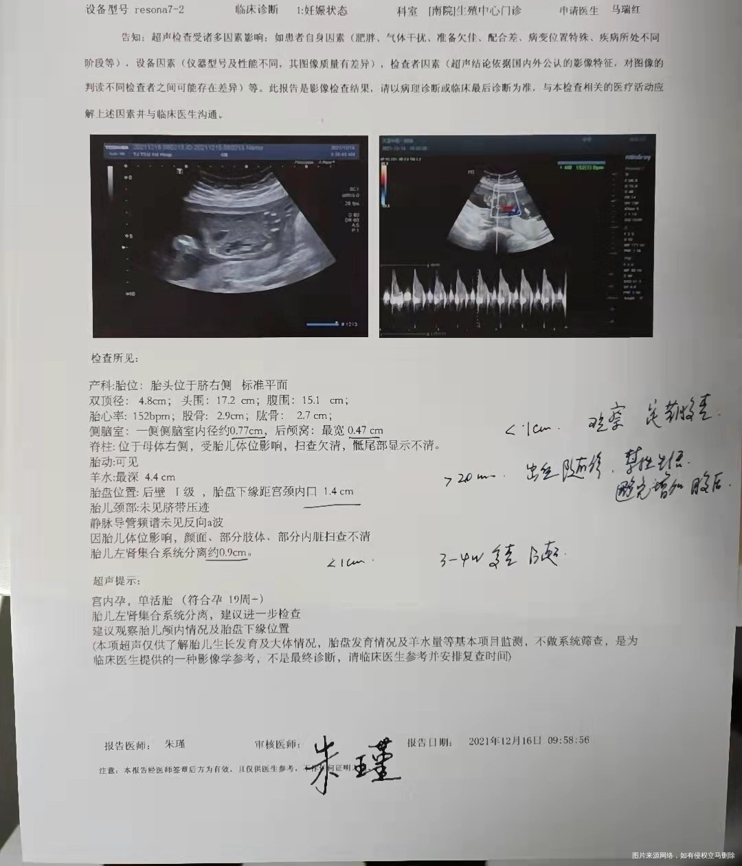 请各位医生大神帮忙看一下b超报告19周+2胎