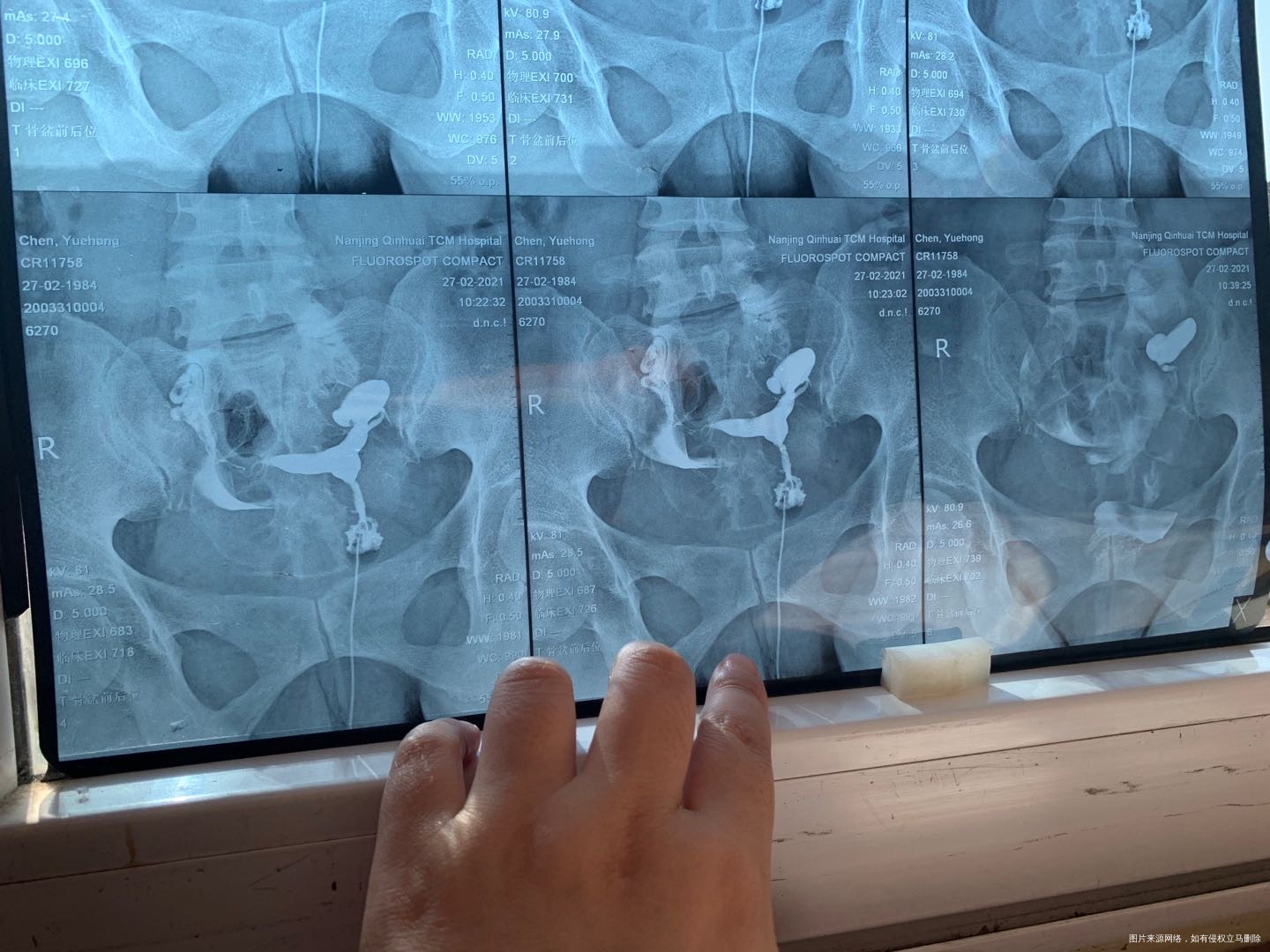 请问我这个造影片子有什么问题做试管需要先处理