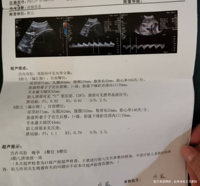 双胞胎有一个臀位一个横位怎么改变作息睡姿坐姿