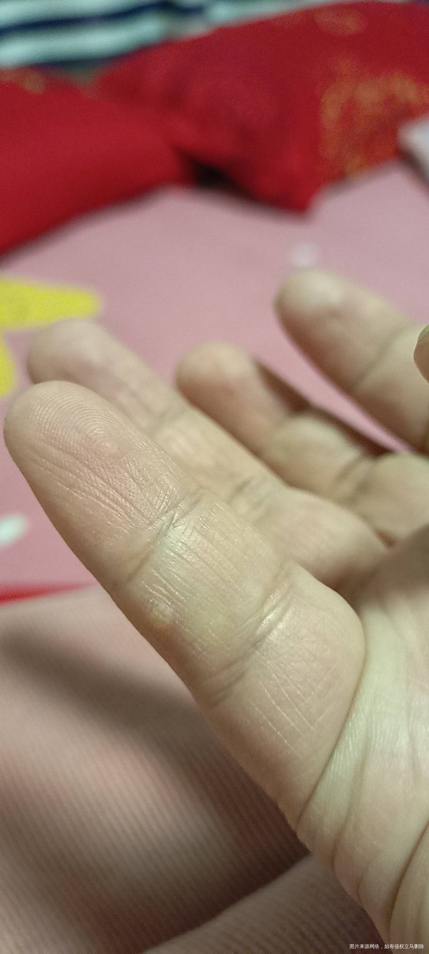 孕前小拇指上长疣激光去了可能不干净在原来的地