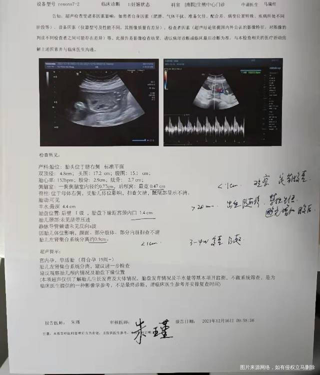 孕19周+21胎儿左肾集合系统分离09cm2