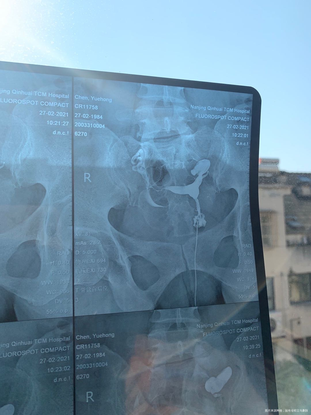 请问我这个造影片子有什么问题做试管需要先处理