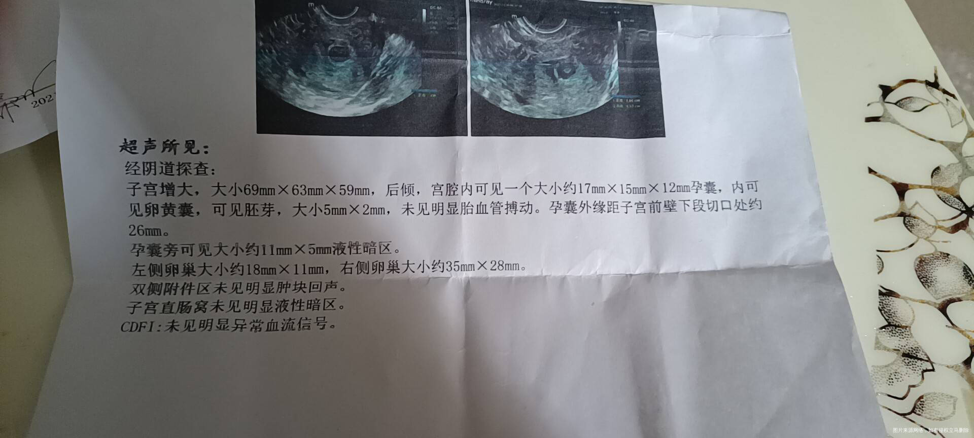 最后一次例假11月5号今天做B超还没有血管搏