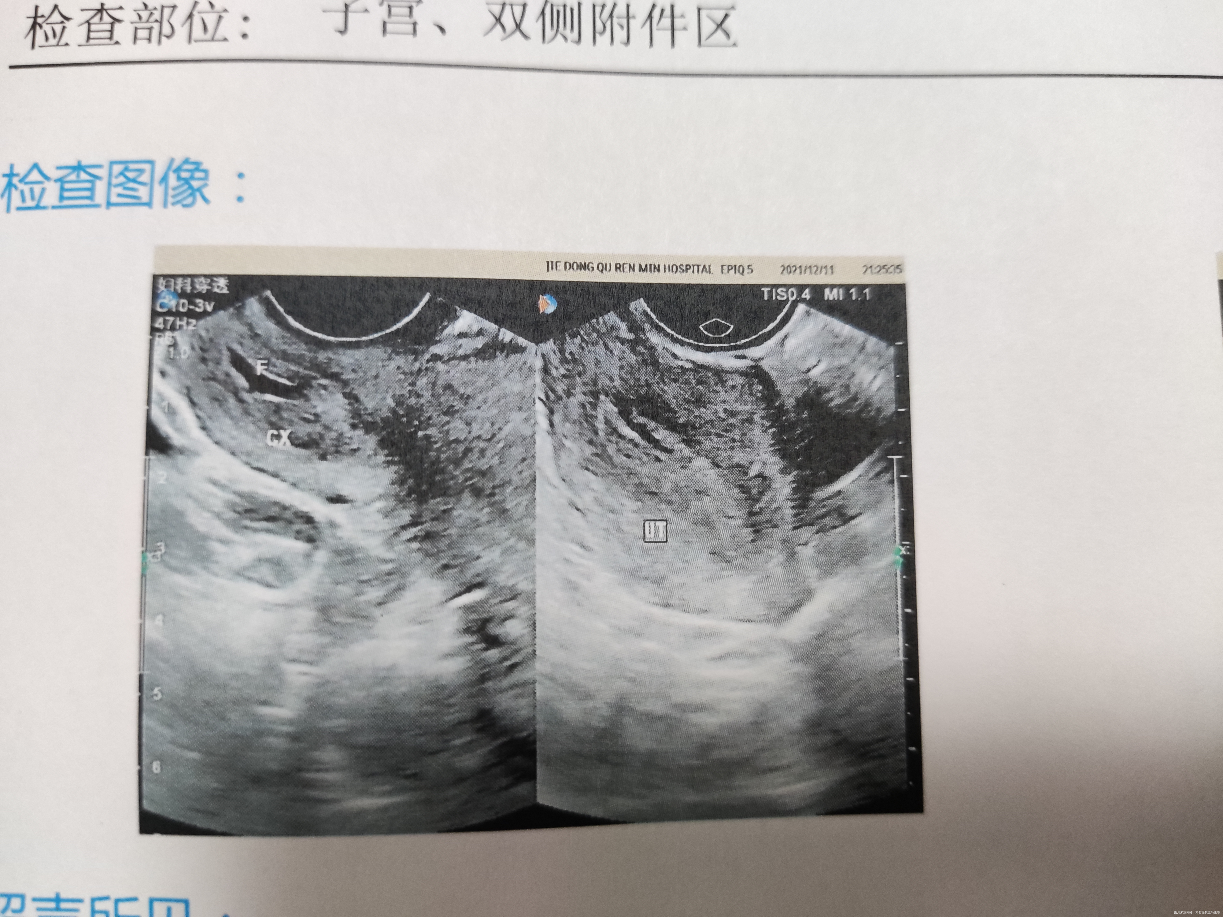 医生好我被诊断为宫外孕目前hcg为500多b