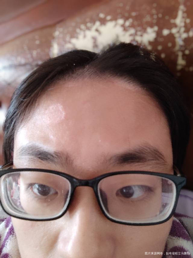 想知道我脑门这块和头皮上是什么是癣吗还是脂溢