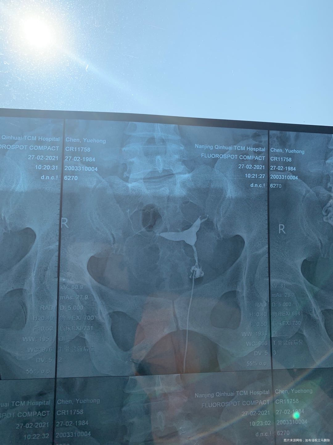 请问我这个造影片子有什么问题做试管需要先处理