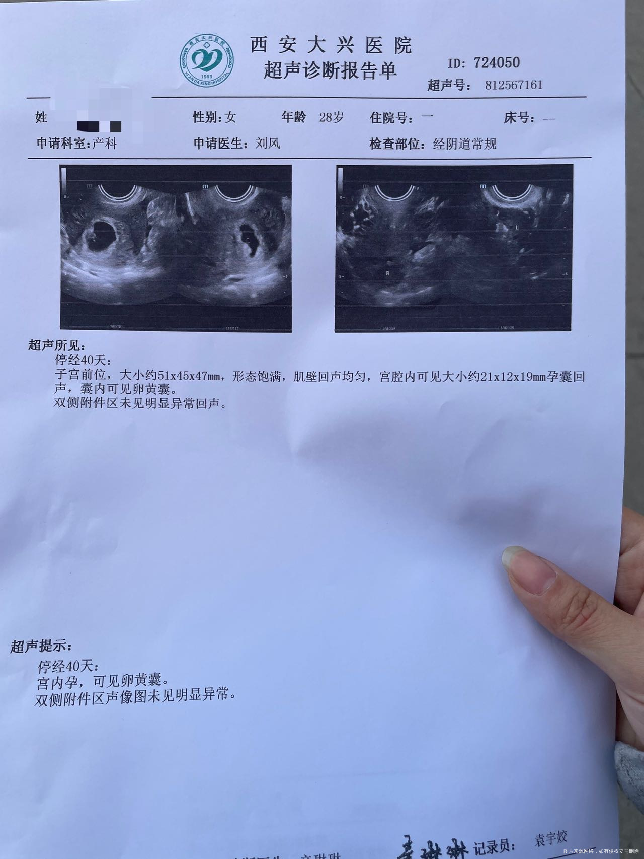 囊胚移植第20天做了b超孕囊发现比正常值偏大