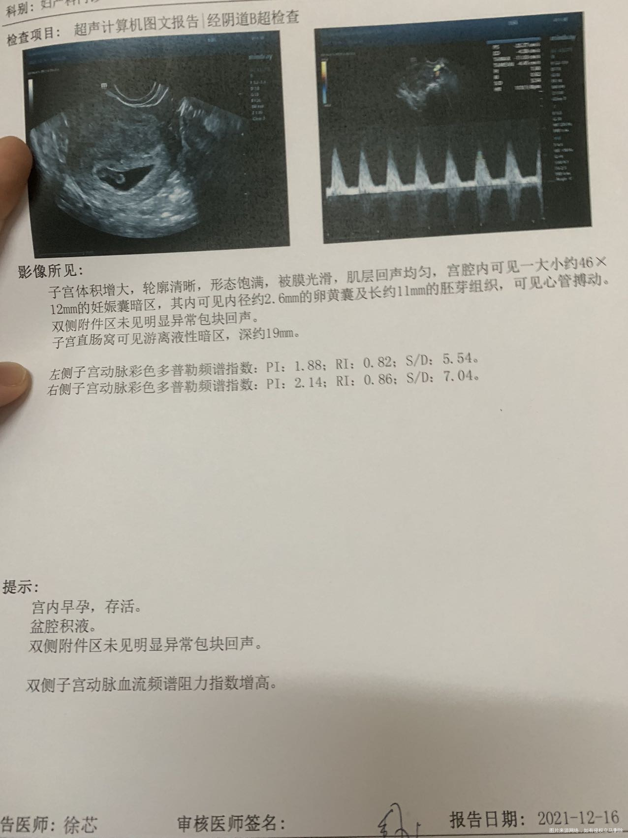 1025末次麻烦看看报告卵黄囊怎么会变小同一