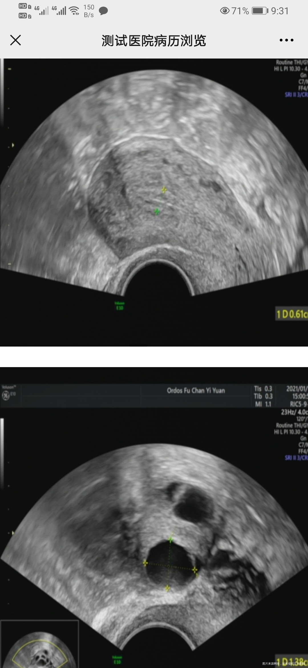 这是宫外孕保守治疗后3个月复查B超突然发现卵