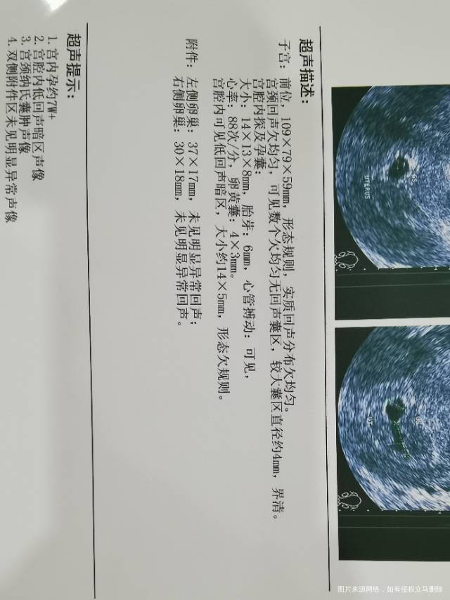 鲜胚移植第41天请问医生还有没有希望的崩溃了