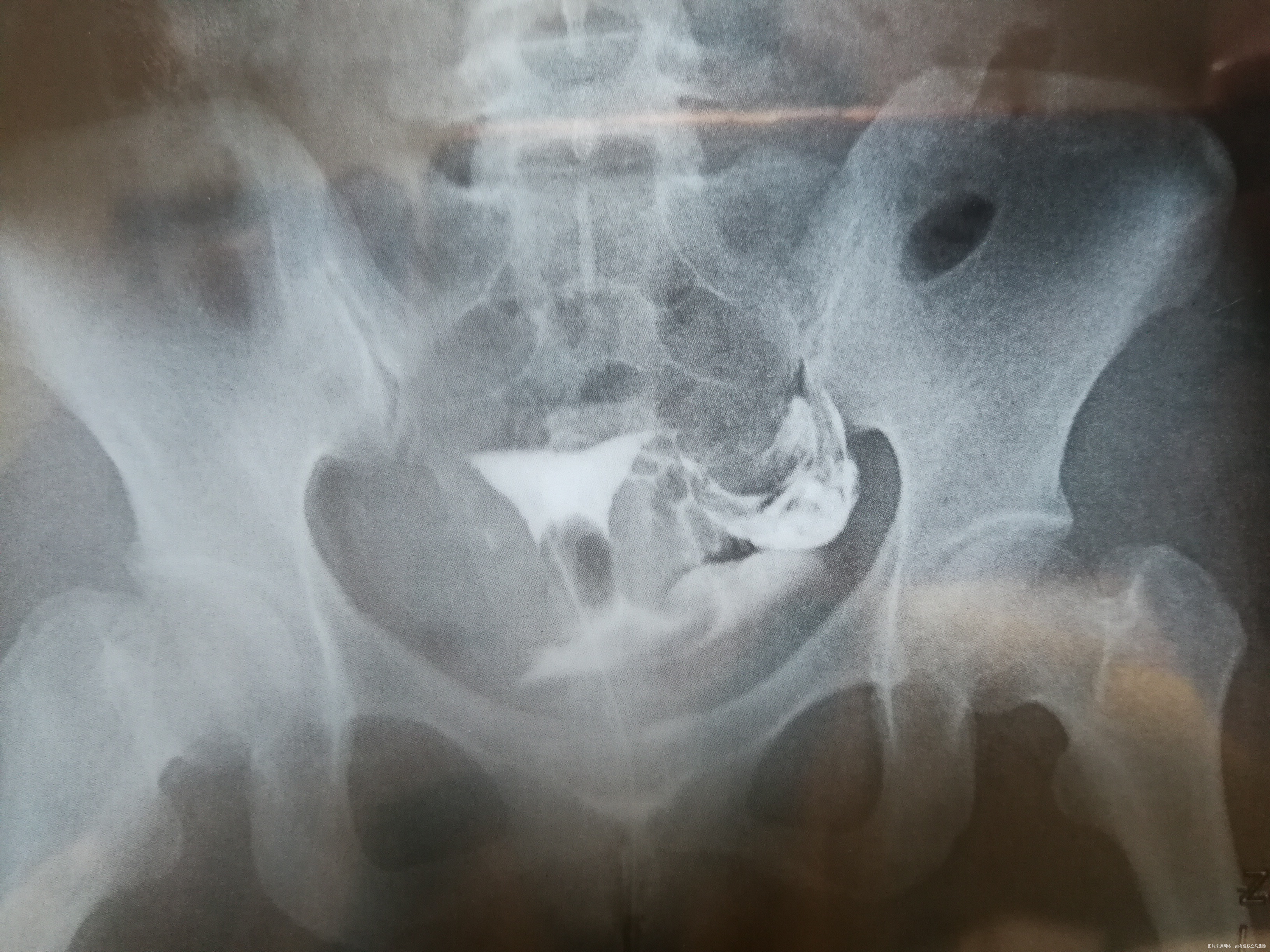 医生您好我已婚32周岁有痛经多年未采取避孕措