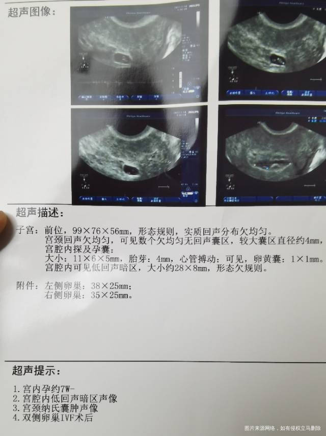 请问医生B超是什么意思胎心胎芽正常吗还有没有