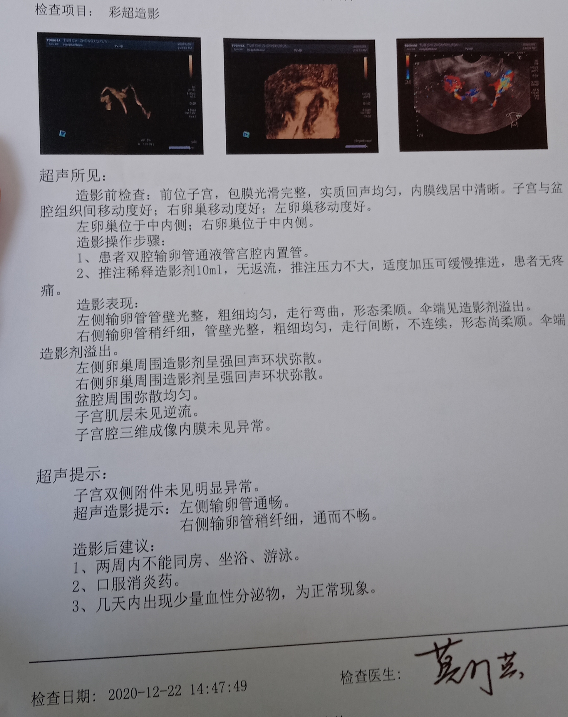 右侧输卵管稍纤细通而不畅可以用右侧输卵管进行