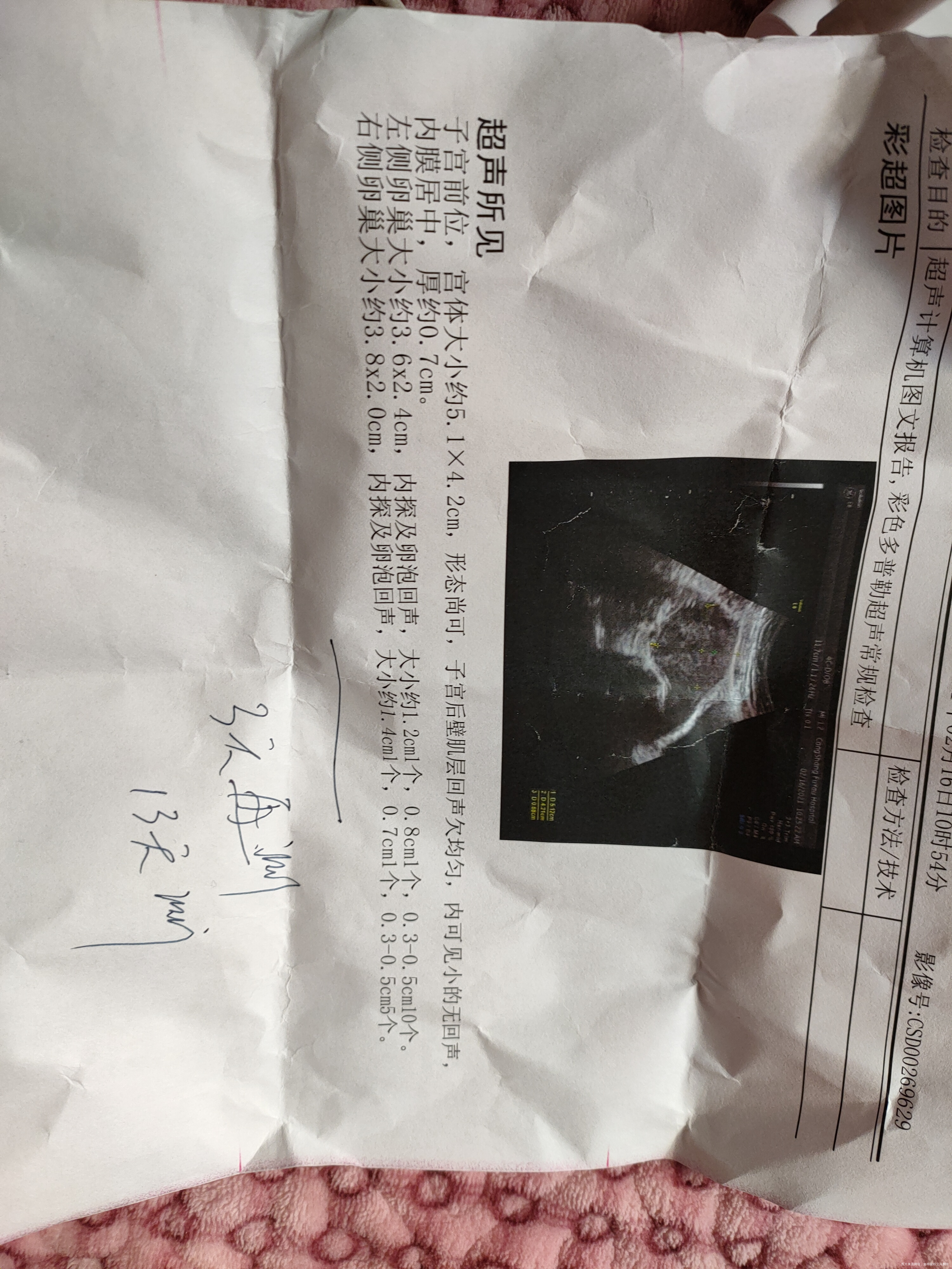 多囊这个月促排吃来曲五天2月19号右侧卵泡2