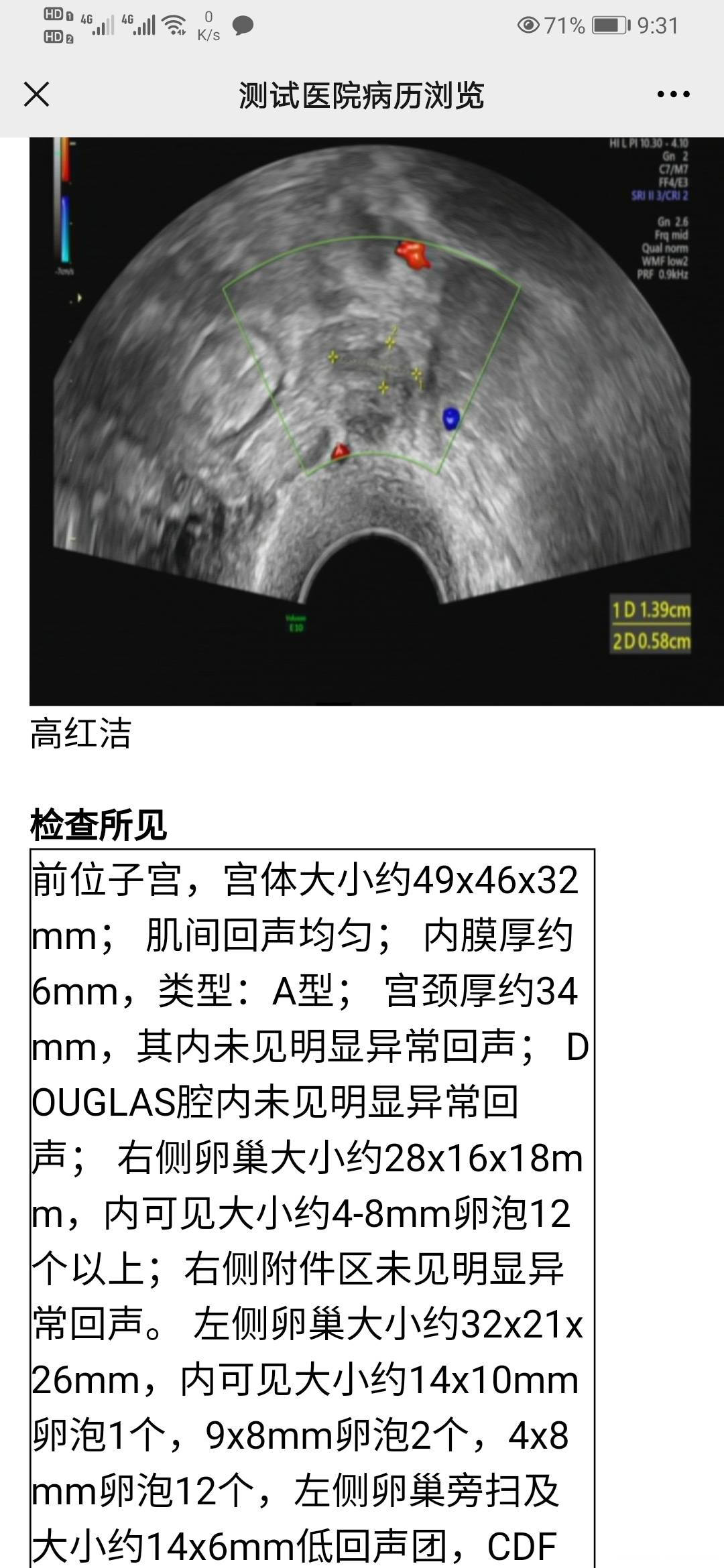 这是宫外孕保守治疗后3个月复查B超突然发现卵