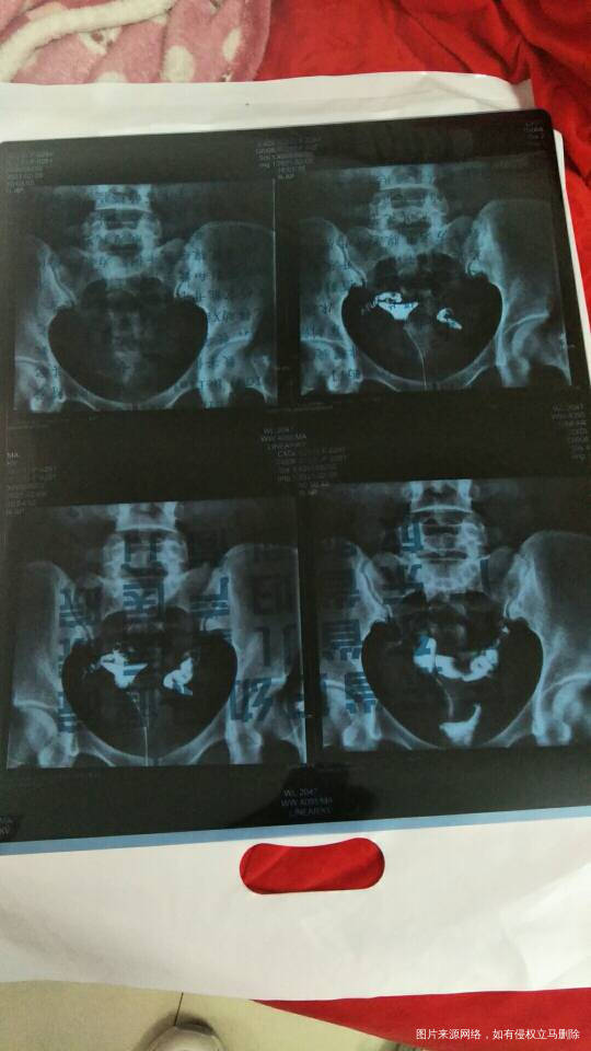 请问这个报告能排除输卵管积水和输卵管伞端粘连