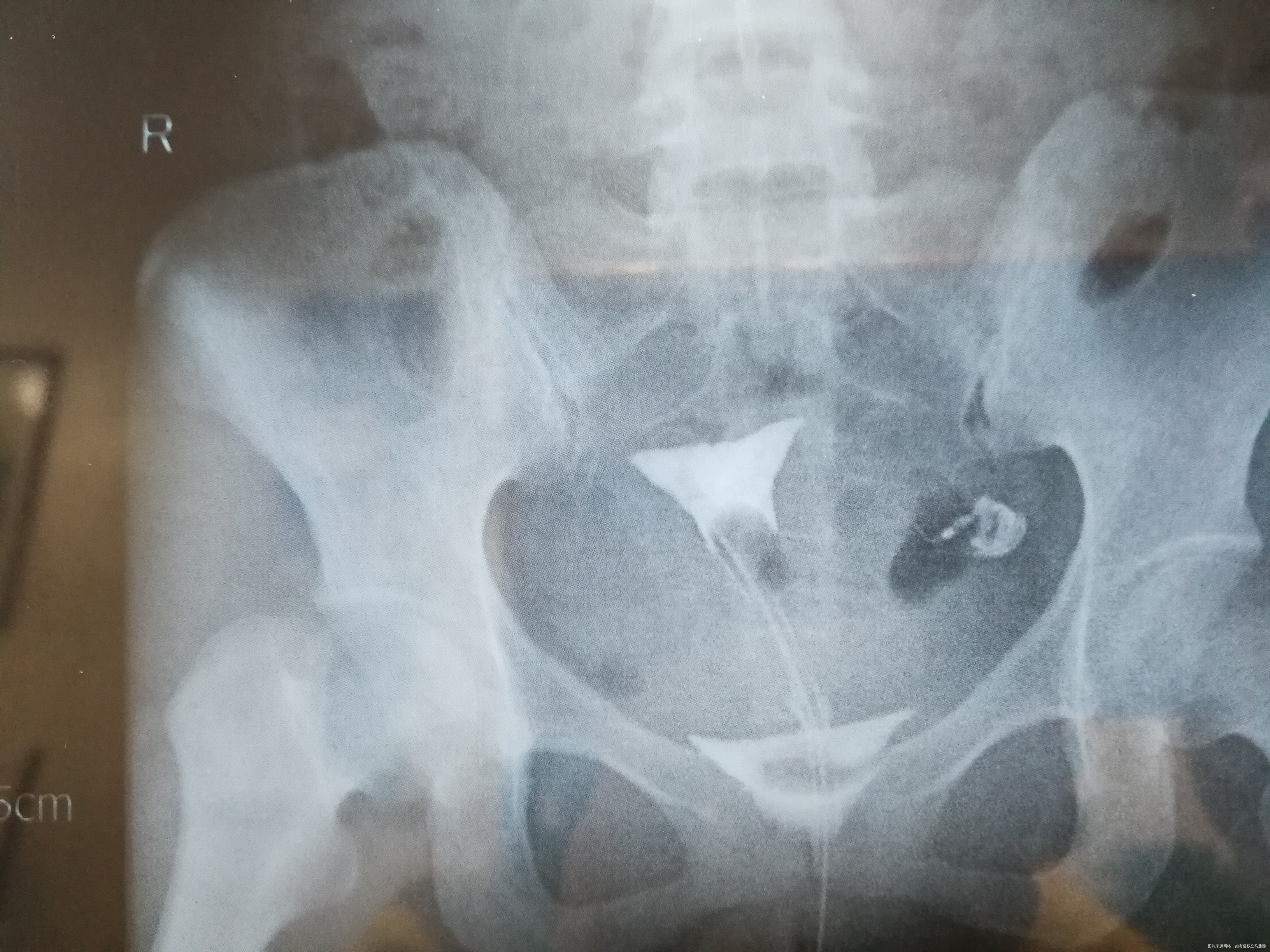 医生您好我已婚32周岁有痛经多年未采取避孕措