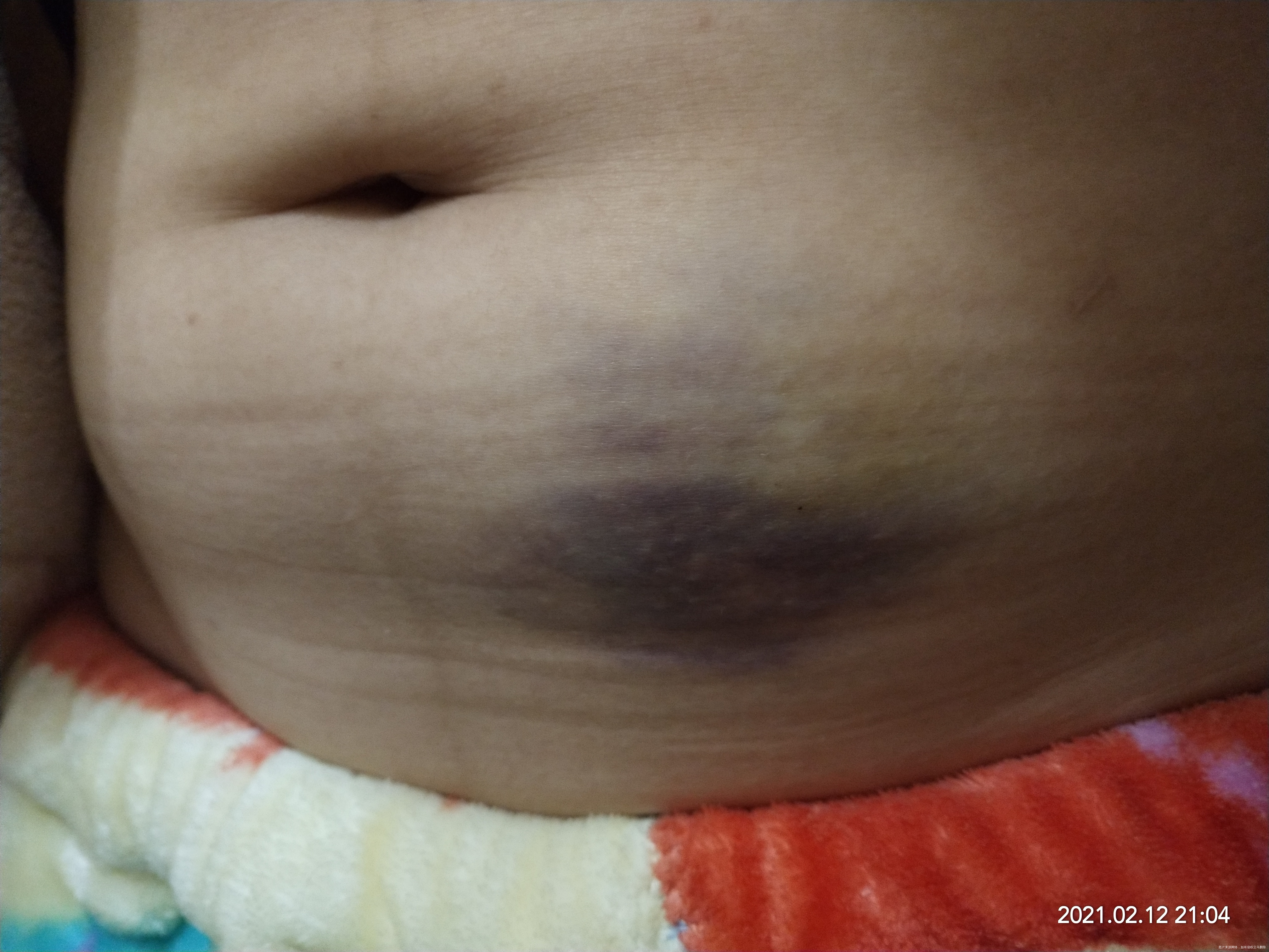 医生新年好我现在孕六周凝血高四周开始打肝素吃