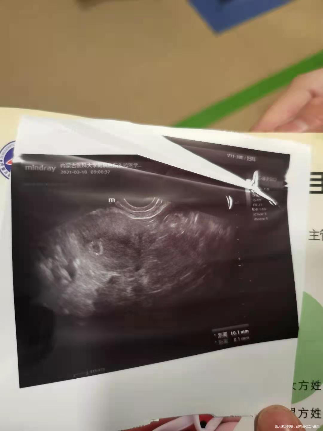 移植21天的一超请帮我看一下有没有问题呢