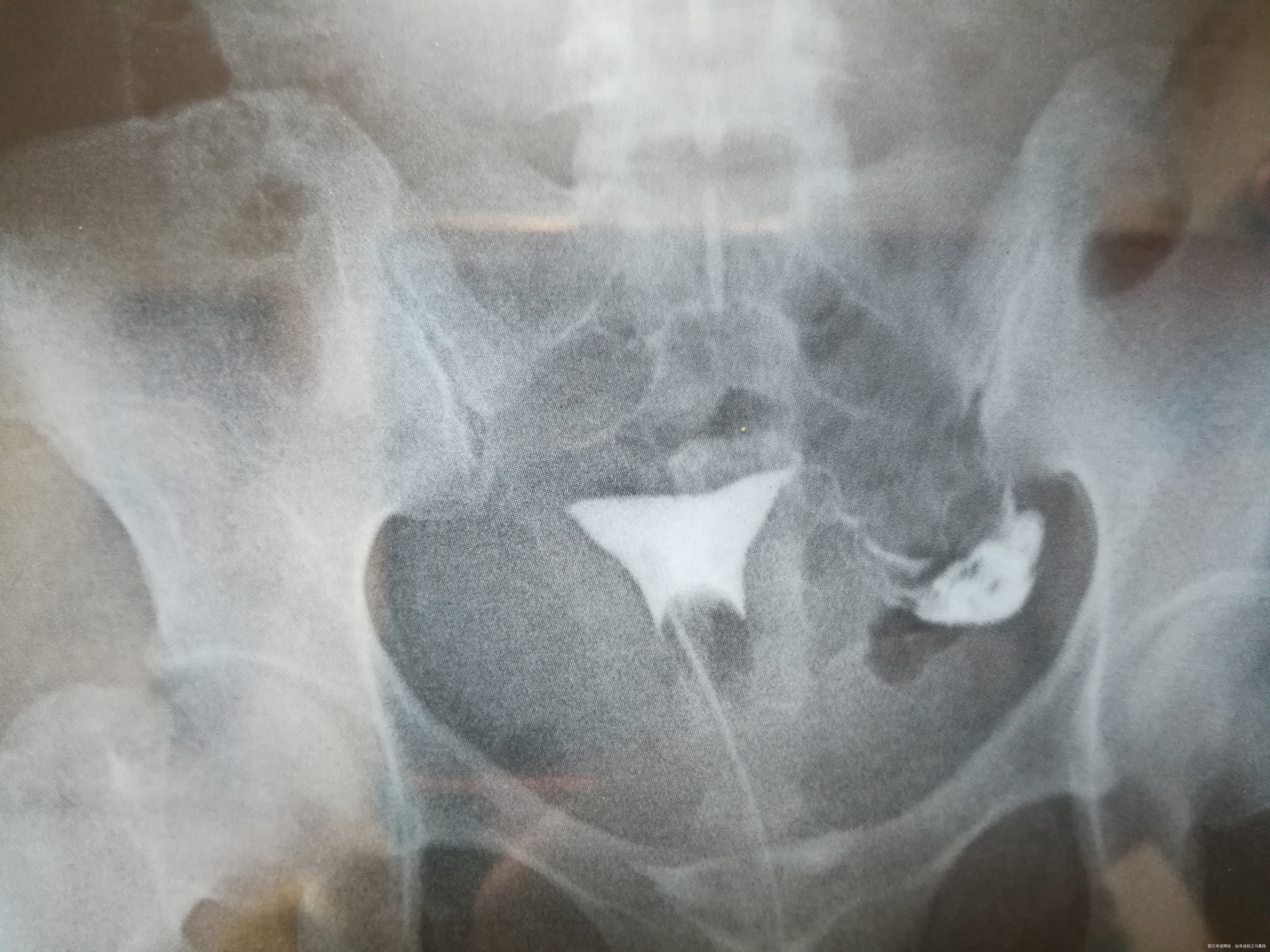 医生您好我已婚32周岁有痛经多年未采取避孕措