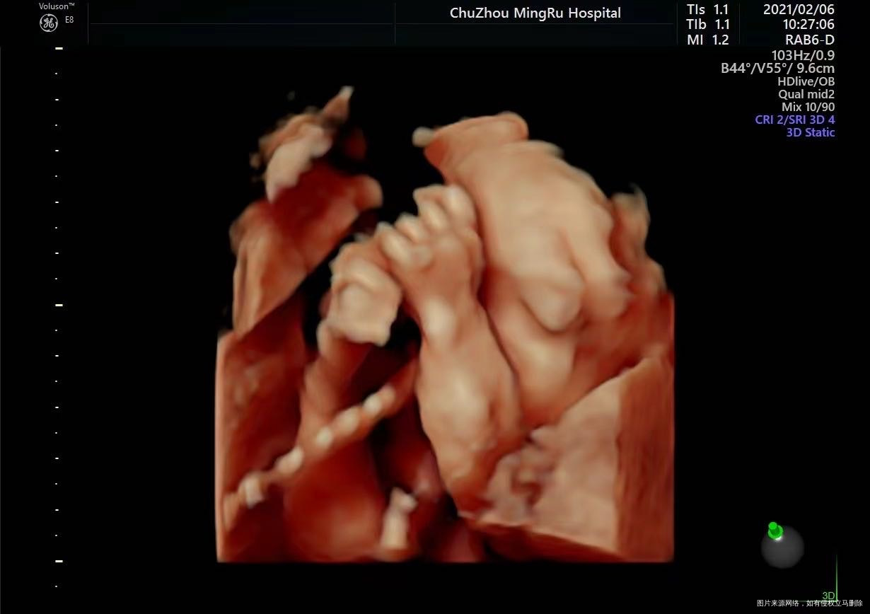 现在24周这个脐带有问题吗是不是有点扭