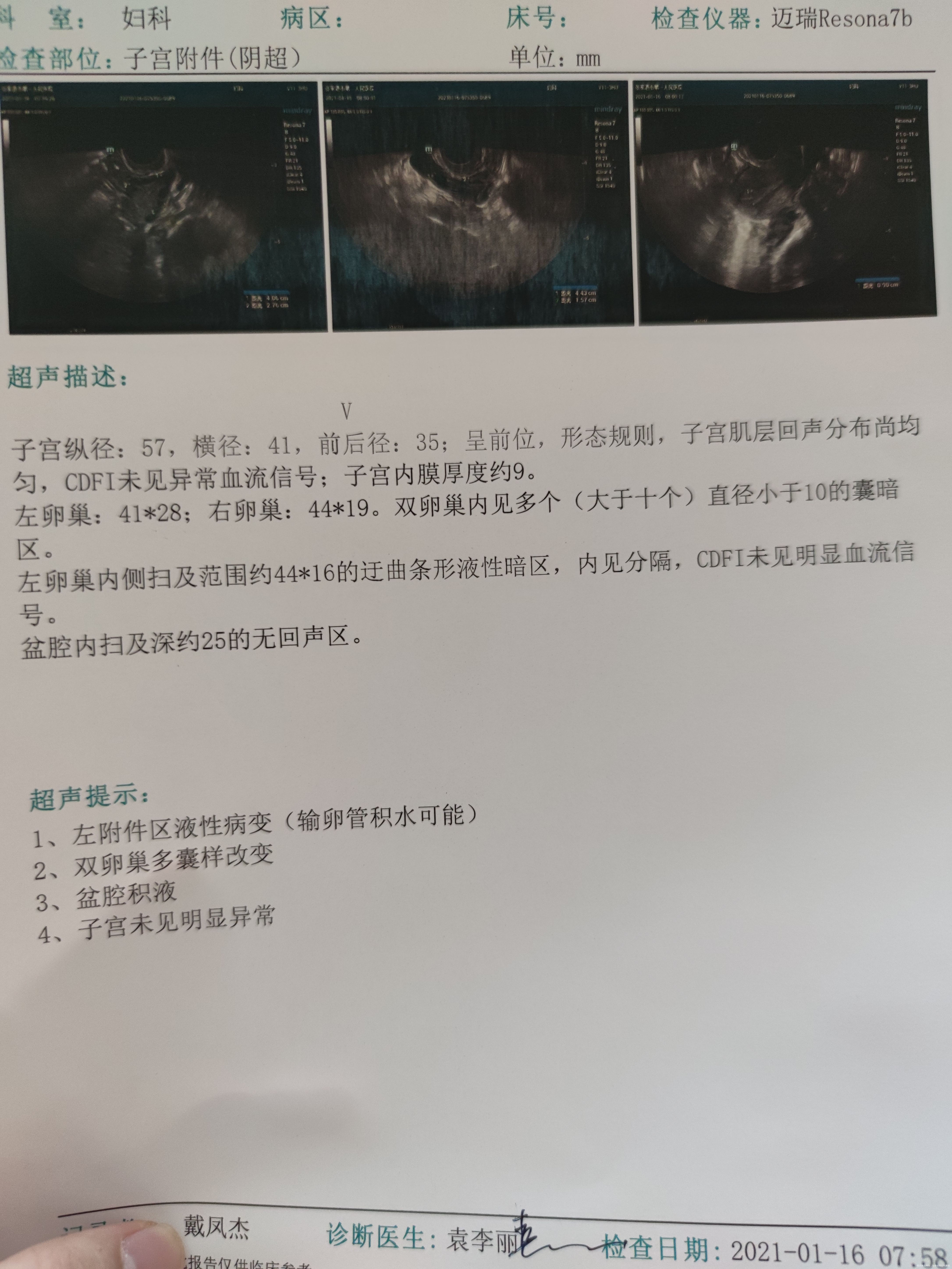 我是多囊但是我的月经周期很规律30天以前做b