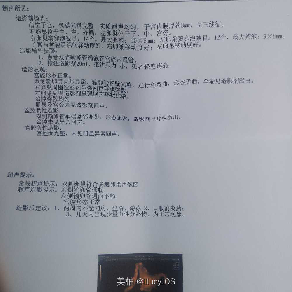 多年前刮宫过一次后来前两年检查出来多囊吃达英