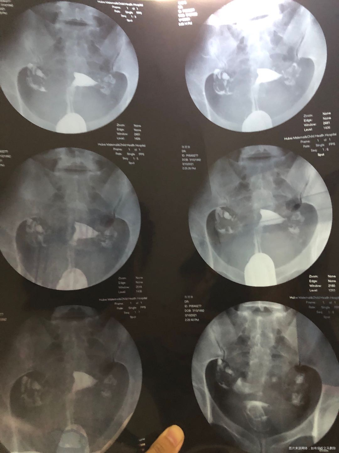 一子十岁隔年人流一次19年宫外孕保守治疗右侧