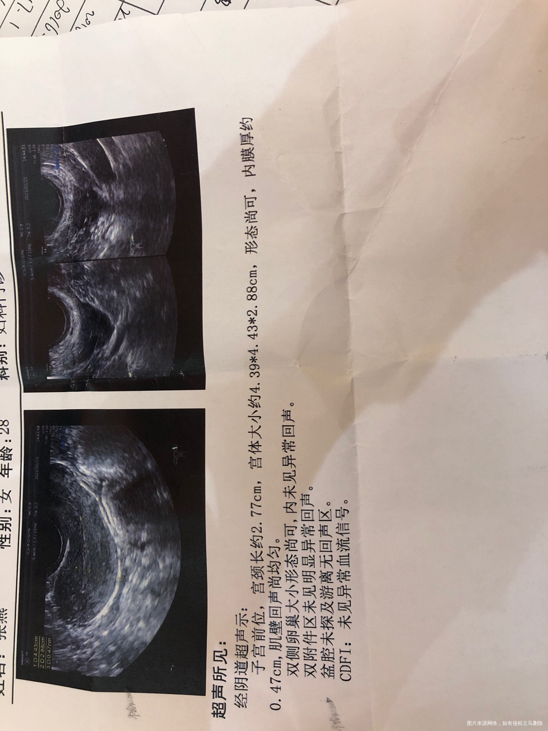 一九年四月份做了流产手术胎停四个月没有发现胎