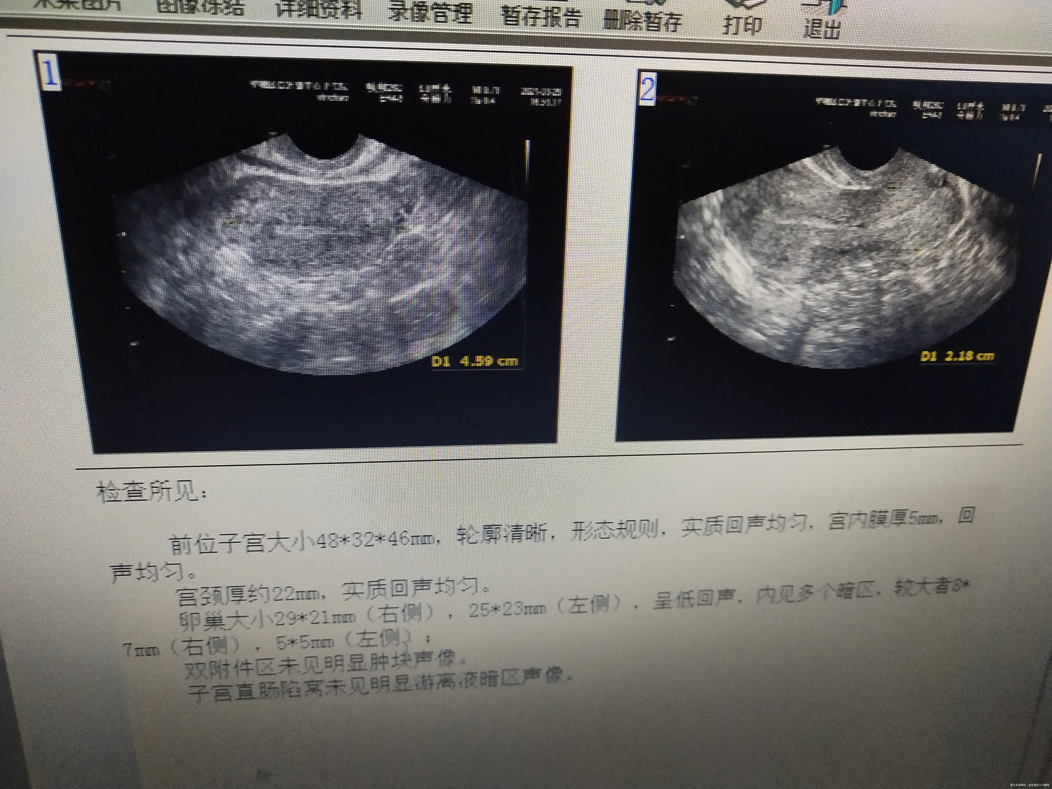 生化妊娠后两个月没来月经想要怀孕怎么处理