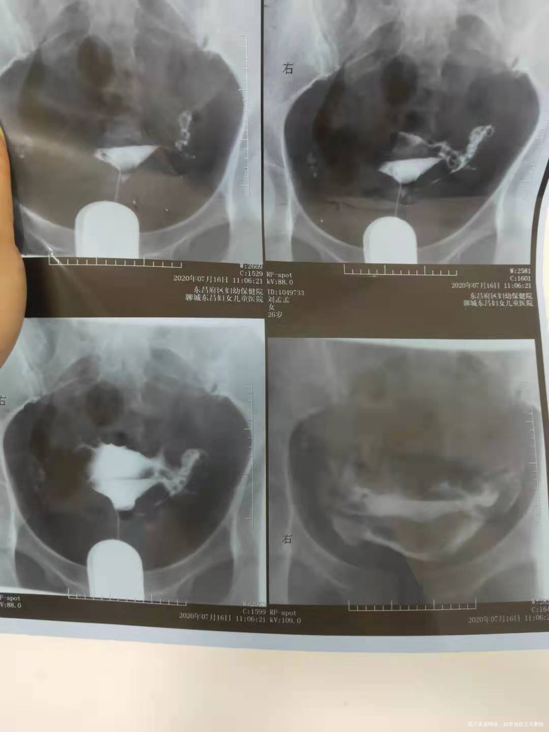 两年未孕20年7月做的造影有自怀的希望吗