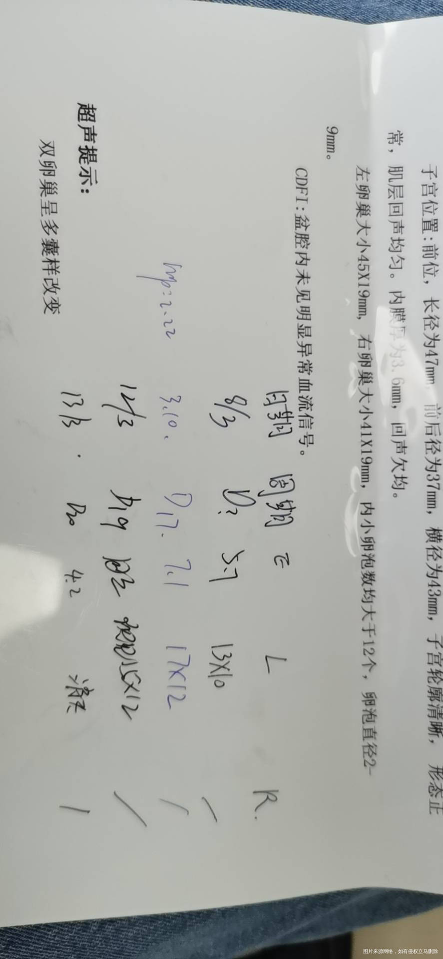 多囊卵巢综合征雄激素高吃达英3个月后进行促排